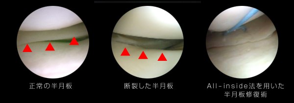膝靭帯手術のすべて 膝靱帯手術のすべて | 越智 光夫 |本 | 通販 | Amazon